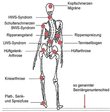 Bil eines Skelettes mit Schmerzpunkten